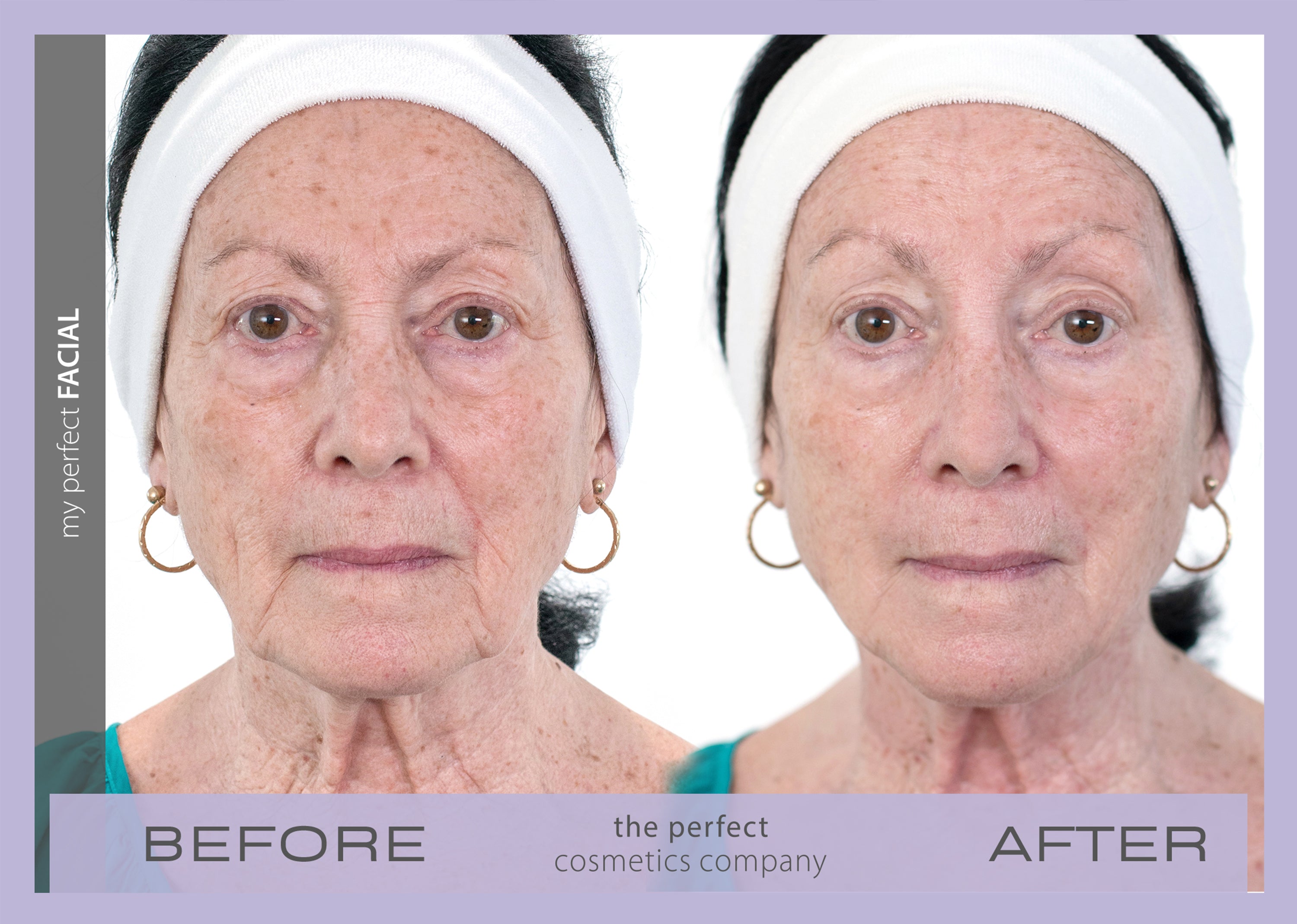 My Perfect Facial before and after results showing visible skin tightening and reduced wrinkles, delivering non-surgical facial rejuvenation for a youthful appearance.